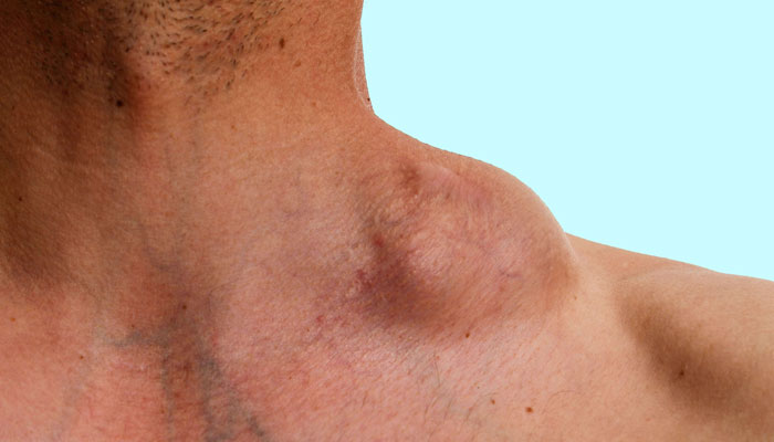 Lymphoma Treatment