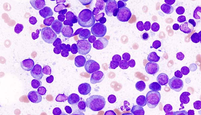Multiple Myeloma Treatment