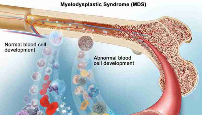 Myelodysplastic Syndromes Treatment