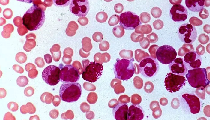 Myeloproliferative Disorders Treatment