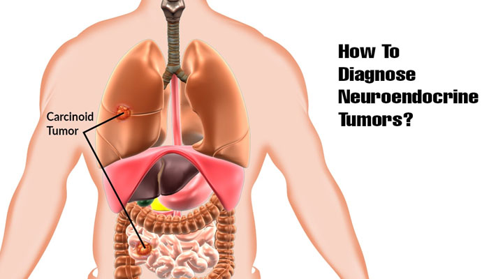 Neuroendocrine Tumor Treatment
