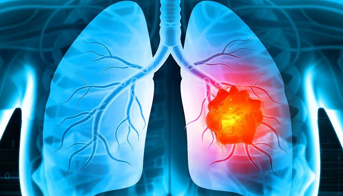 Lung Cancer Treatment