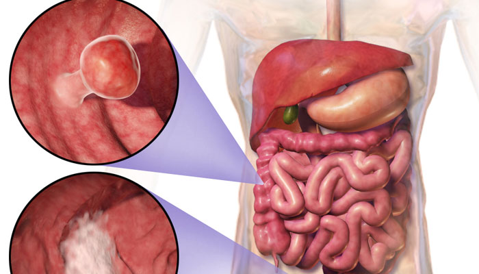 Colorectal Cancer Treatment