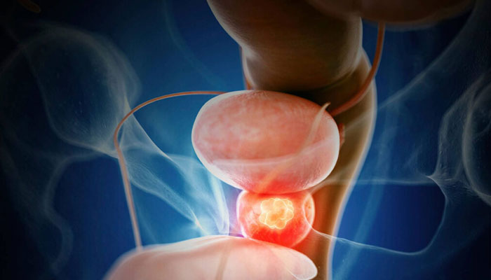 Prostate Cancer Treatment