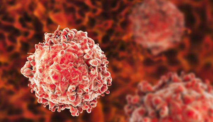 Leukemia Treatment